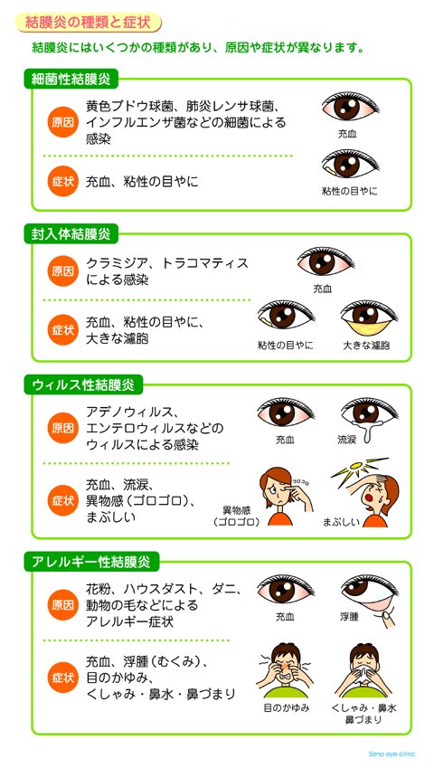さの眼科: 結膜炎